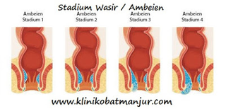 Illustration for article titled cara mengobati ambeien secara herbal